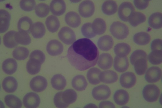 If your kisses can't hold the man you love... mononucleosis will!